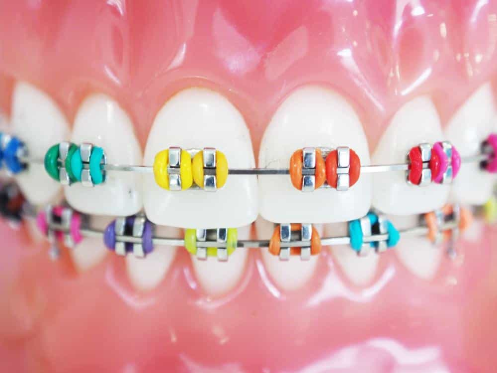 https://izmircocukdishekimim.com/wp-content/uploads/2021/11/early-orthodontics2.jpg